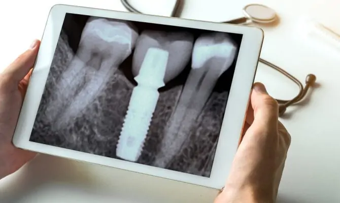 80-YEAR-OLD DERRICK HAD HIS IMPLANTS AT LIKYA DENT